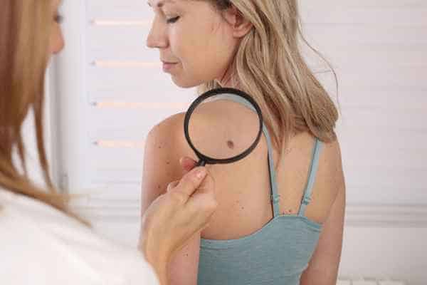What Are Traditional Skin Lesion Removal Methods Gravesend?