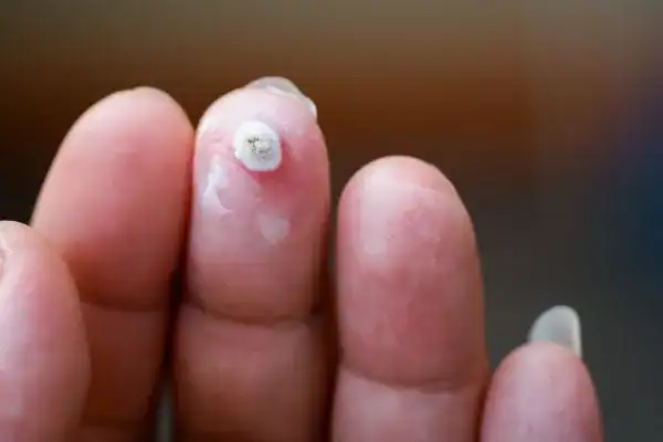 Image of white wart before cryopen treatment Gravesend