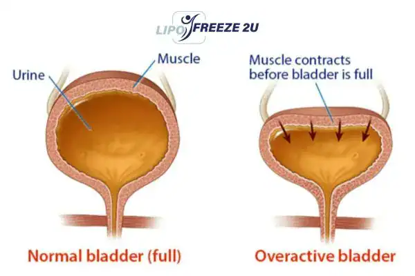 diagram of overactive bladder treatment Gravesend