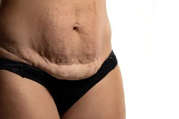 loose skin after weight loss injections Gravesend