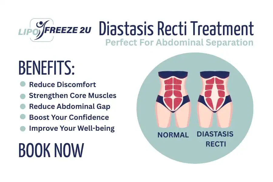 How Long Will It Take to See Improvements in Diastasis Recti Gravesend