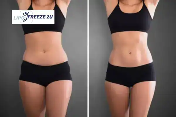 How Can LIPO FREEZE 2U Support Your Post-Pregnancy Body Recovery Gravesend?