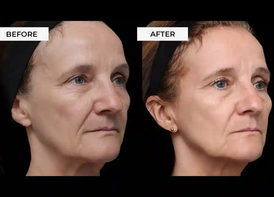 How Many RF Microneedling Sessions Will You Need to See a Difference Gravesend?