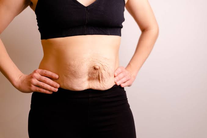 Is Surgery Really the Only Way to Repair Diastasis Recti Gravesend?