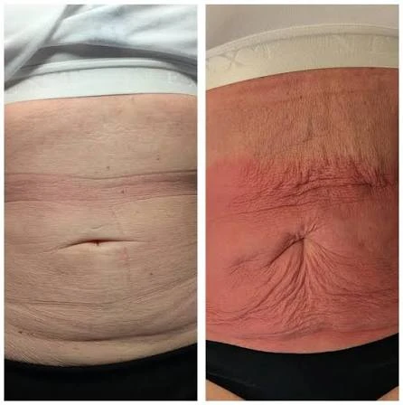How Does RF Microneedling Improve Crepey, Thin and Uneven Skin Texture Gravesend?
