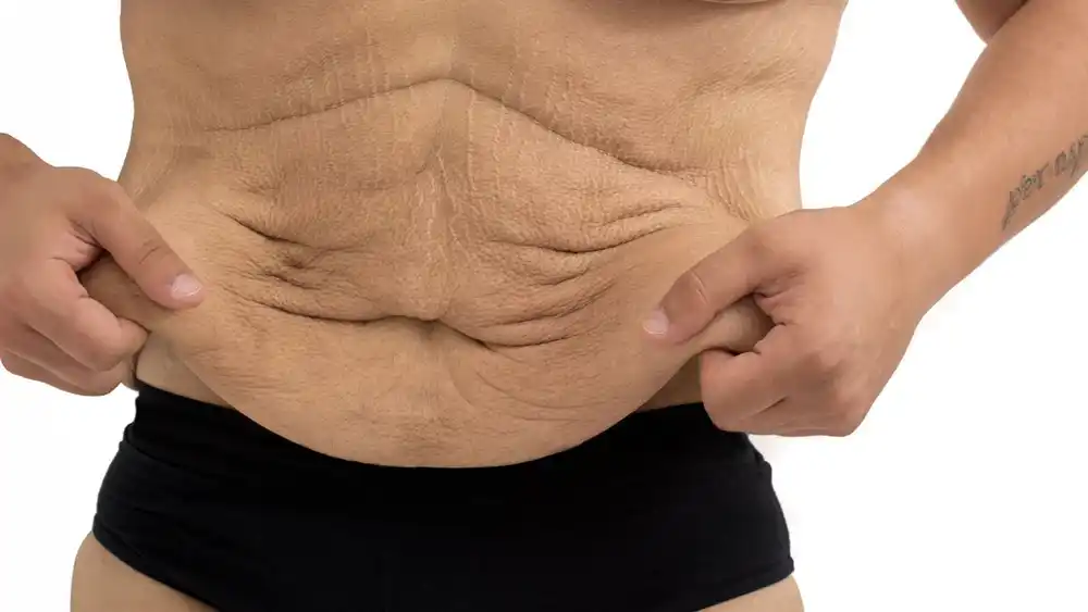 RF Microneedling for Loose Skin: How Can It Help Tighten and Reshape the Skin Gravesend?